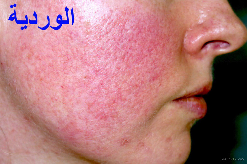 هل اللحمة الوردية تختفي؟ كل ما يجب معرفته عن اللحم الوردي