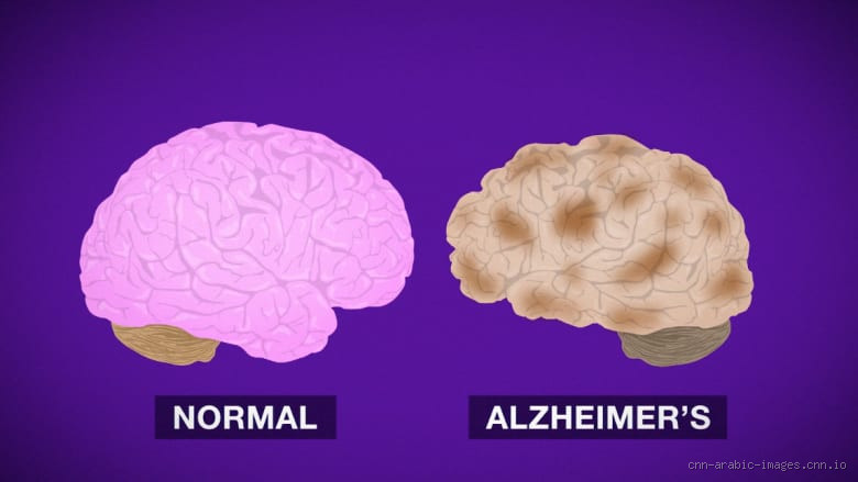 هل مريض الزهايمر لا ينام؟ كيف يؤثر المرض على النوم؟