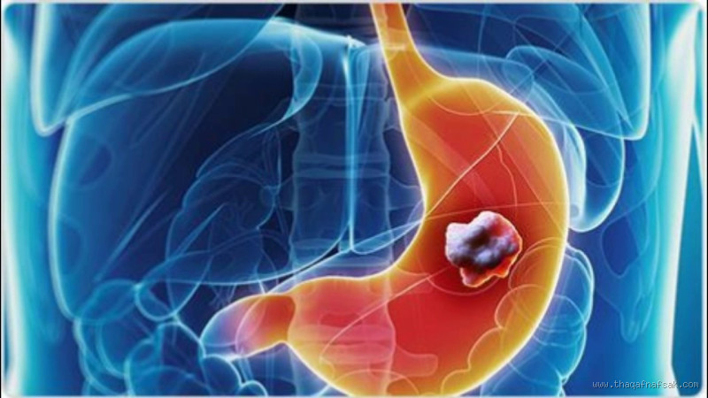 هل ينتشر سرطان المعدة بسرعة؟ اكتشف الإجابة الحاسمة