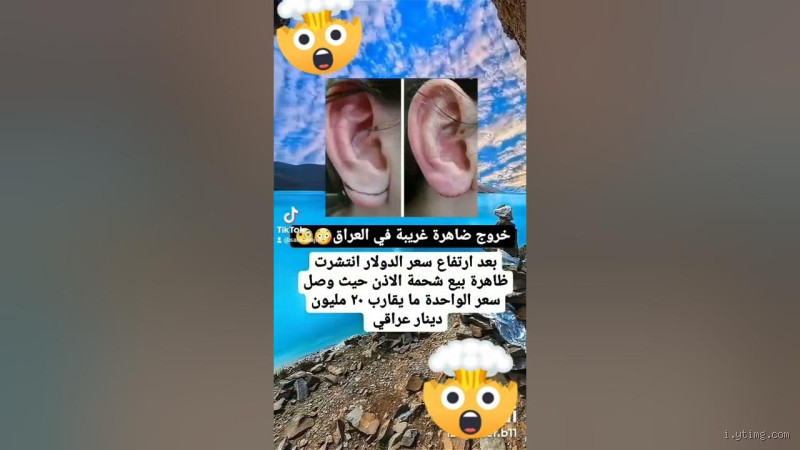 هل عملية شحمة الأذن في العراق غالية أم رخيصة؟