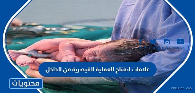 كيف أعرف أن العملية القيصرية التأمت من الداخل؟