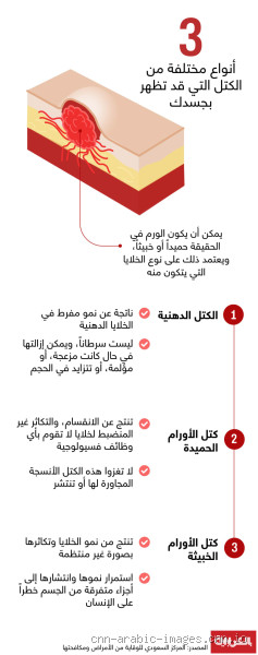 كيف اعرف ان الكتلة غير سرطانية؟ دليل للاطمئنان والراحة النفسية