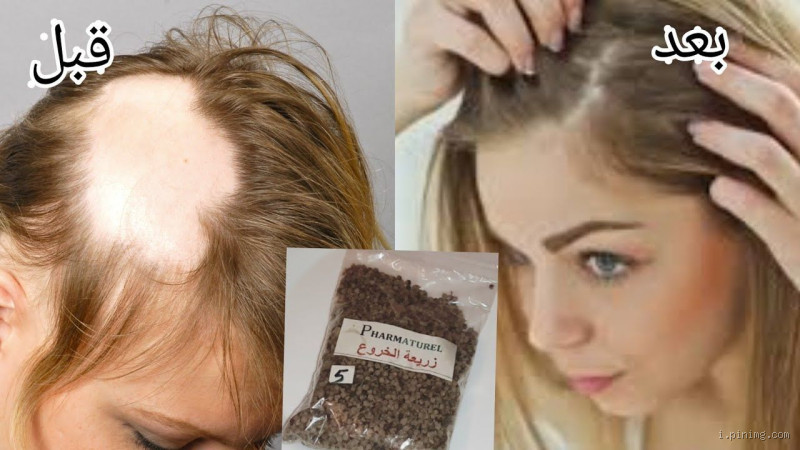 كيف تنبت فراغات الشعر؟ نصائح وحلول فعّالة