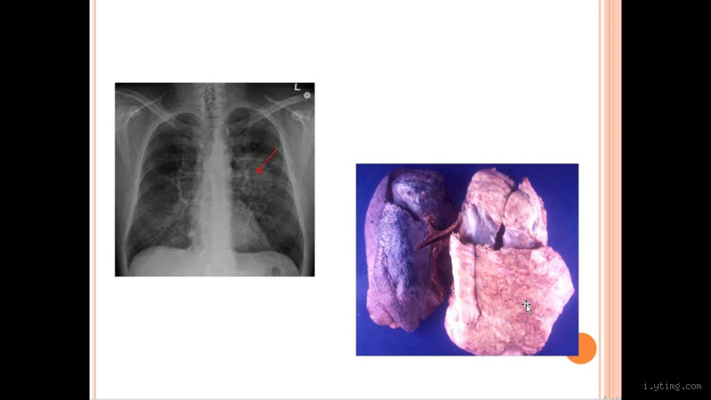 كيف يكون شكل الكتلة الخبيثة؟ تعرف على الأعراض والأسباب