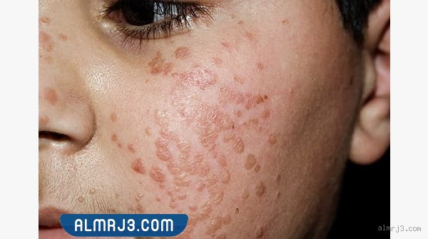 كيف يكون شكل الثالول في البداية؟ تعرف على أعراضه وطريقة التعرف عليه