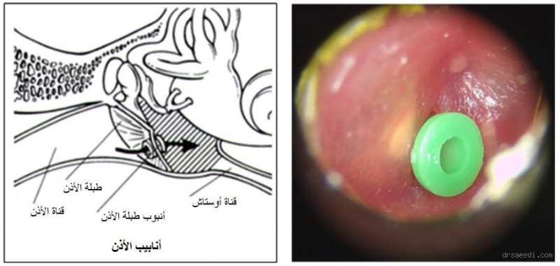 متى تسقط أنابيب الأذن؟